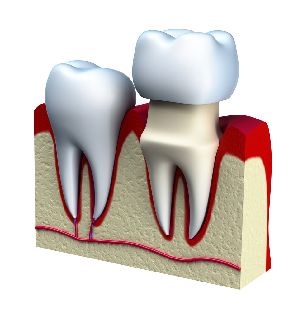 graphic of dental crown