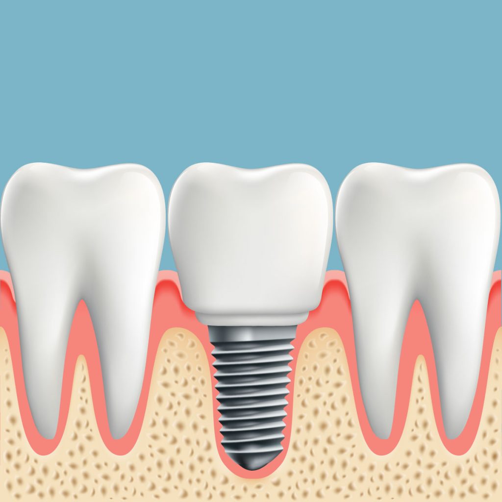 Dental Implant Placement & Restoration | Eagle Rock Dental
