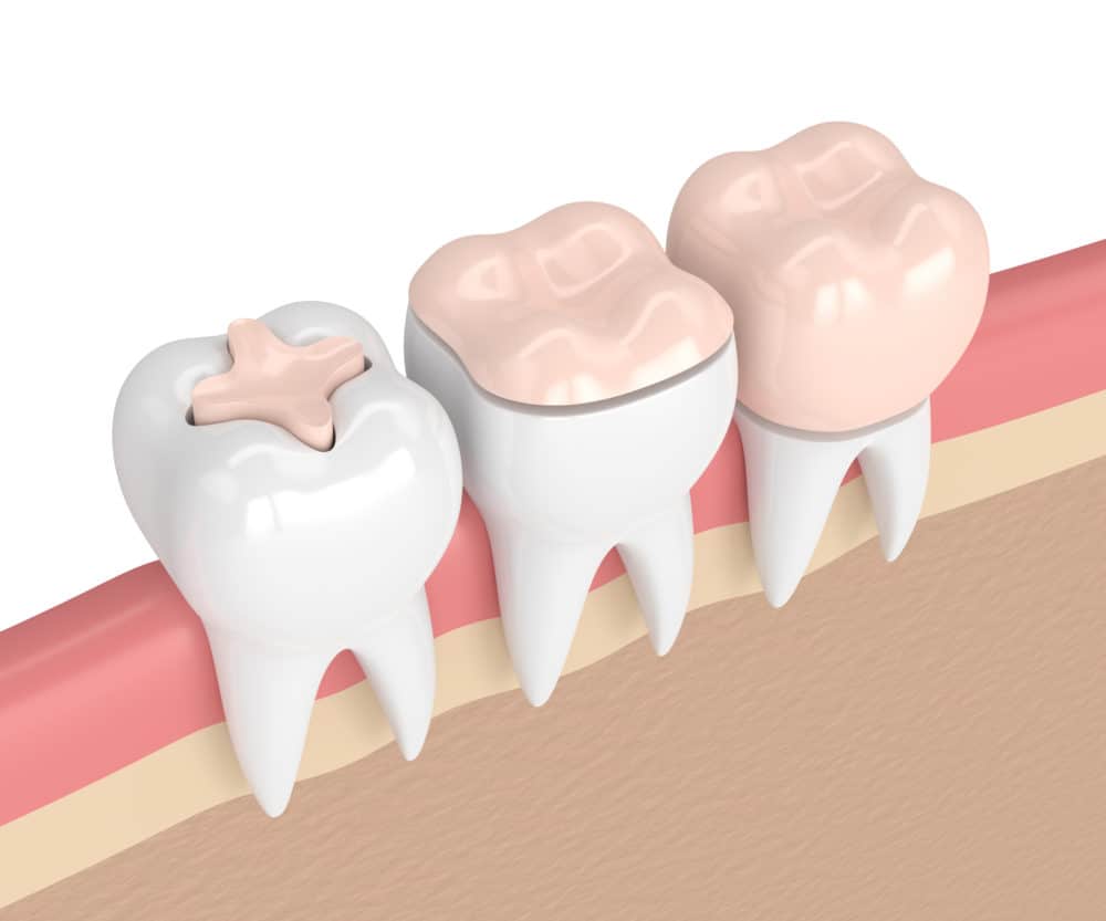 3d render of teeth with inlay, onlay and crown filling in gums