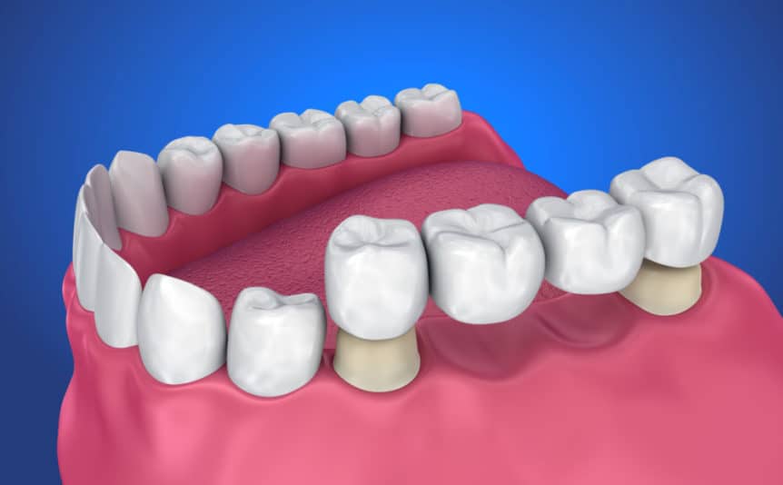 Tooth supported fixed bridge. Medically accurate 3D illustration